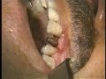 Implante Friccional KOPP