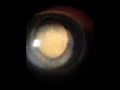 Macarena Cataract