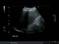 Liver coronal uncompressed