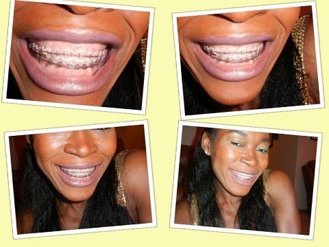 how to whiten braces elastics