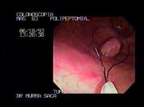 Colonoscopy of a polypectomy of a ...