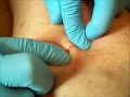 Cyst #2- Part 3 (The Budding Cauliflower)
