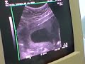Pablete mi bebe de 18 o 20 semanas
