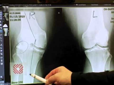 how to decide when to have knee replacement