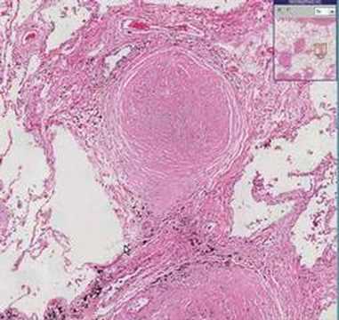 Histopathology Lung--Silicosis