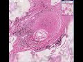 Histopathology Lung--Silicosis Histopathology Lung--Silicosis