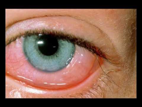 how to cure giant papillary conjunctivitis gpc