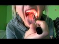 tonsils before surgery