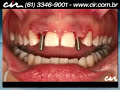 Implantes dentários com carga imediata
