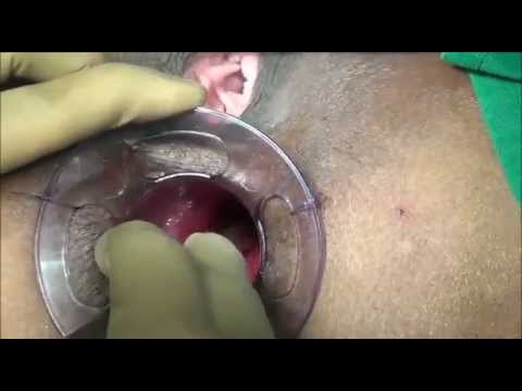 STARR Surgery for Chronic Constipation Treatment|Healing Hands Clinic