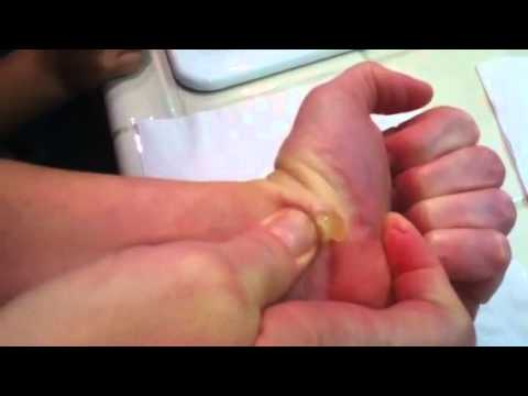 how to drain a cyst on your wrist