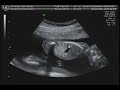 Ecografía 17 semanas Mellizos Niño Álvarez-Campana Parte I Ecografía 17 semanas Mellizos Niño Álvarez-Campana Parte I