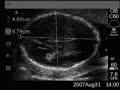 Ultrasound