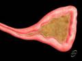 Best treatment for Sinusitis