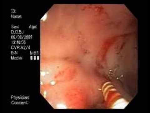 how to make an ulcer bleed
