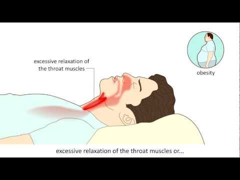 how to cure sleep apnea