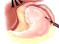 PreOp® Patient Education Hernia Hiatal Laparoscopic Surgery2  GERD Hernia