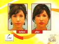 DALLAS FACE LIFT ALTERNATIVE:  NO-INCISION PLASTIC SURGERY