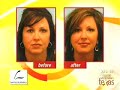 DALLAS FACE LIFT ALTERNATIVE:  NO-INCISION PLASTIC SURGERY