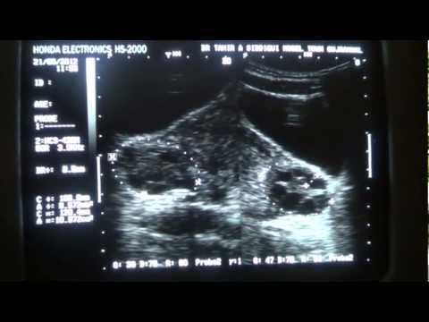 how to locate ovaries on ultrasound