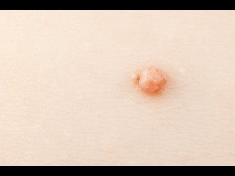 how to get rid or skin tags