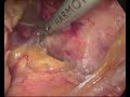 laparoscopic left adrenalectomy laparoscopic left adrenalectomy
