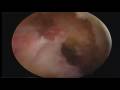James ACL reconstruction... View Video