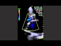 Aortic Insufficiency Aortic Insufficiency