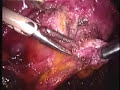 Endometriosis Severa (2º Parte) Endometriosis Severa (2º Parte)