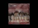 Meth Addiction Detox and Drug Rehab in Florida.wmv