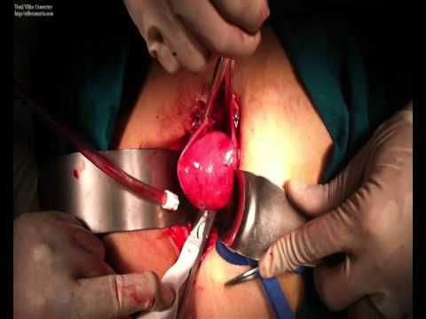 endometrium - 78 YEARS OLD MULTIPAROUS WOMAN C/O OF TWO SUCCESSIVE EPISODES OF POST MENOPAUSAL UTERINE BLEEDING .AFTER EXCLUSION OF URINARY AND RECTAL SYMPTOMS A PELVIC TH...