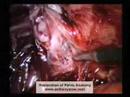 Laparoscopic Restoration of Pelvic Anatomy Laparoscopic Restoration of Pelvic Anatomy