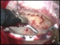 Broken Mitral Valve Chordae - Treatment