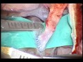 STA-MCA anastomosis: Microvascular anastomosis
