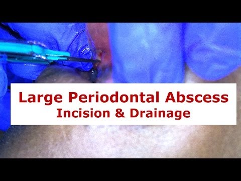 how to drain gingival abscess
