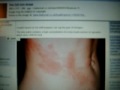 Viral outbreak. Weakened Immune Systems?? 5 Cases Shingles.