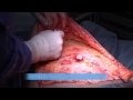 Tummy Tuck, Abdominoplasty, Sydney, Australia by Dr Barnouti
