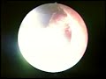 Tonsillectomy Tonsillectomy