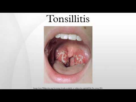 how to cure antistreptolysin o