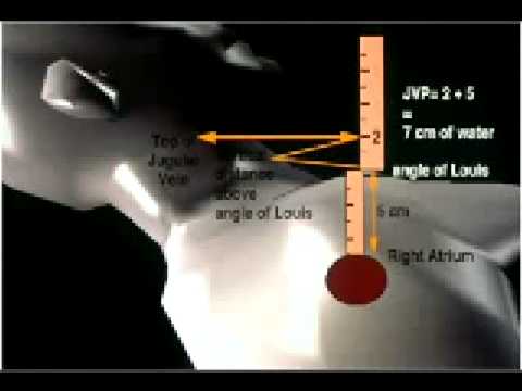 how to assess for jvd