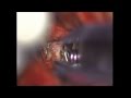 Hemorrhage and Clipping of an Aneurysm in the Brain