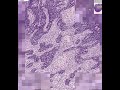 Shotgun Histology Lymph Node