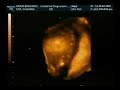 Alan en 4D a las 24 semanas de gestaci�n