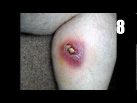 how to treat spider bites nz