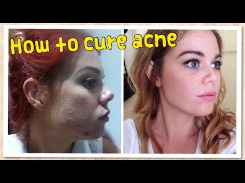 how to cure an acne