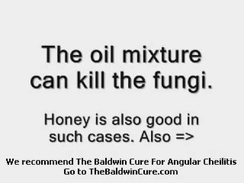 how to cure angular cheilitis
