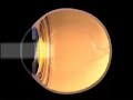 What is a cataract?  Cataract Eye Diseases