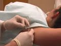 Dr. Coyle Connolly Surgically Removes An Abnormal Mole