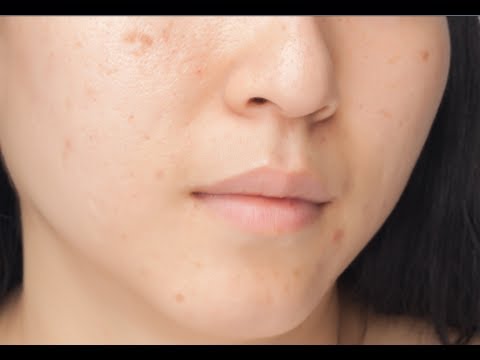 how to eliminate blackheads