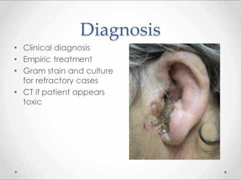 how to cure otitis externa